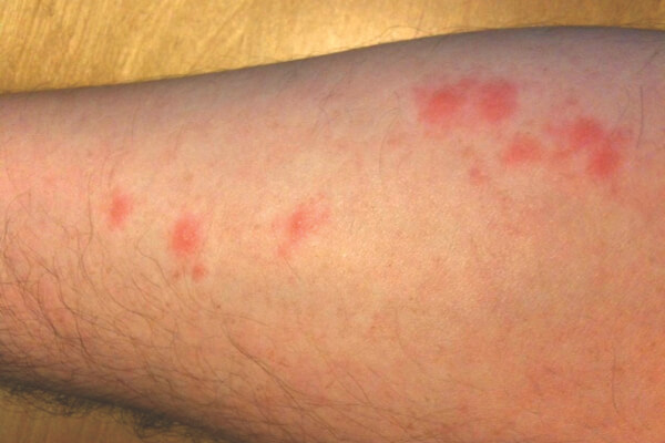 bed bug bite (600 x 400 px)